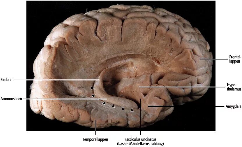 Повреждение гиппокампа. Fimbria гиппокампа. Аммоновы рога у животных. Картинка гиппокампа. Симптомы поражения гиппокампа.