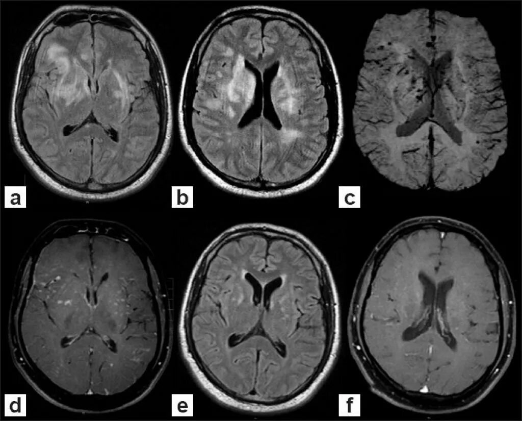Перивентрикулярная лейкоэнцефалопатия мрт. Прогрессирующая мультифокальная лейкоэнцефалопатия кт. Прогрессирующая сосудистая лейкоэнцефалопатия головного мозга. Лейкоэнцефалопатия головного мозга кт. Многоочаговое поражение головного мозга