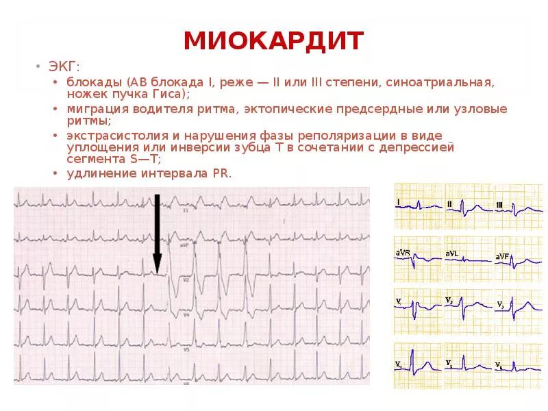 ЭКГ при ревматической лихорадке. Предсердный ритм на ЭКГ. ЭКГ признаки ревматической лихорадки. Миокардит на ЭКГ. Блокада экстрасистолы