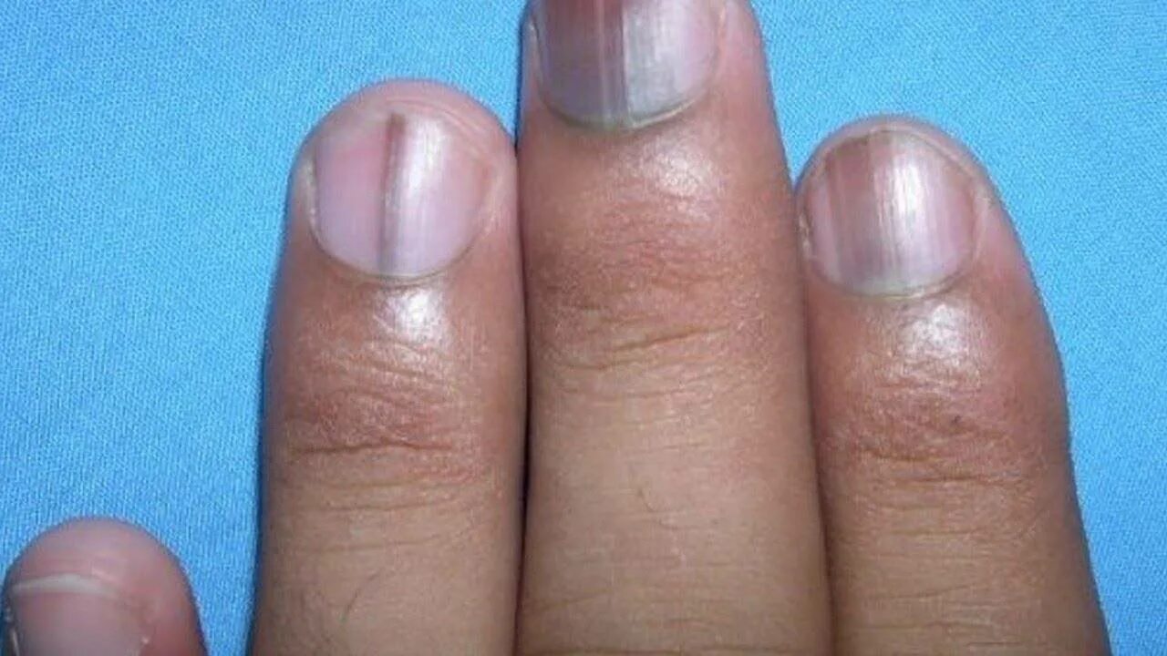 От чего синеют ногти