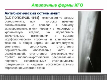 Остеомиелит лечение