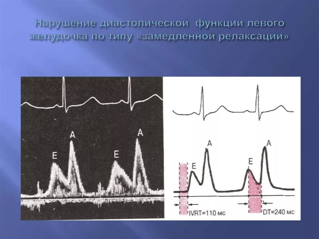 Нарушение релаксации левого желудочка. Диастолическая функция левого желудочка. Типы нарушения диастолической функции левого желудочка. Типы нарушения диастолической функции лж.