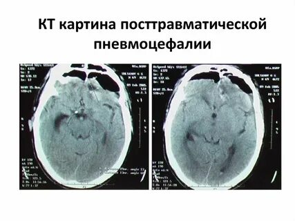Пневмоцефалия
