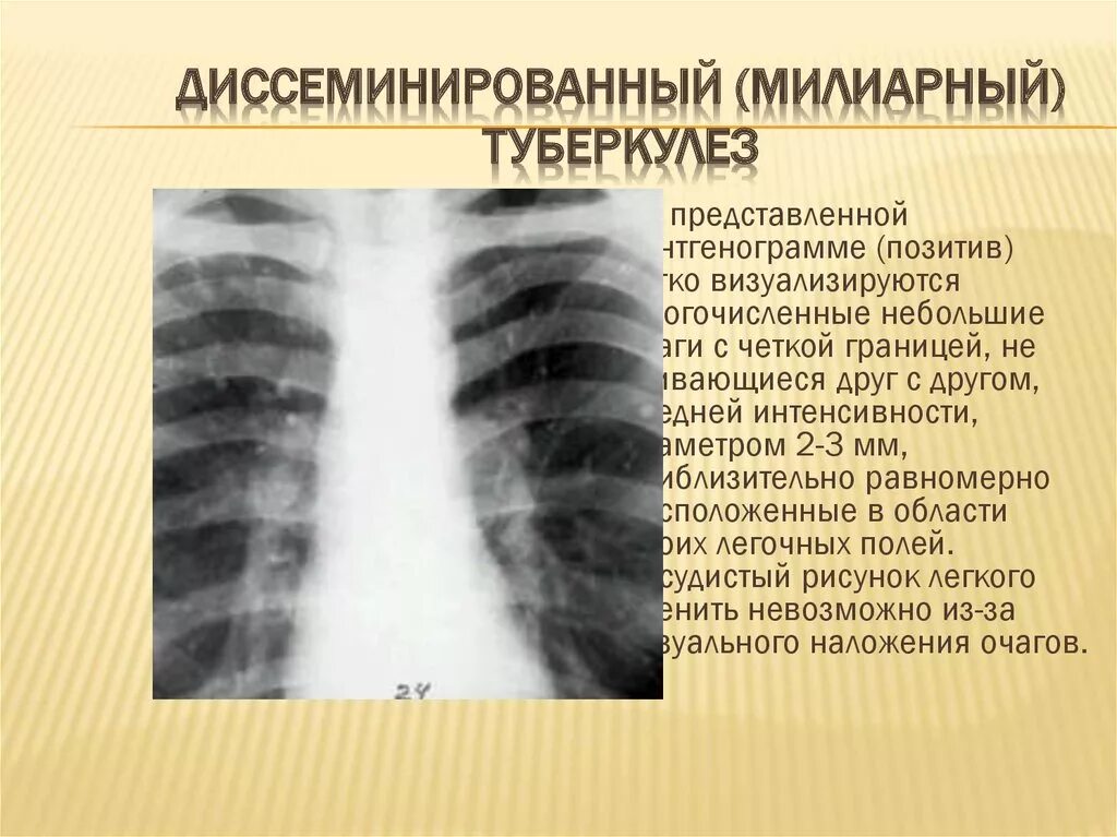 Диссеминированный туберкулез фаза инфильтрации