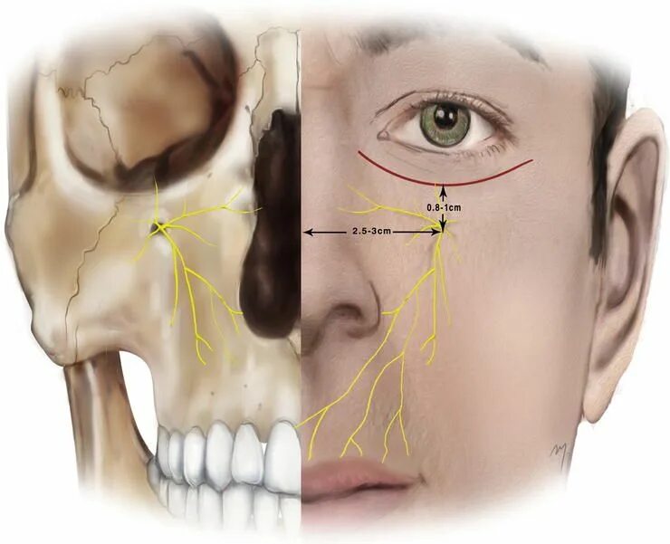 Повреждение тройничного. Подглазничный нерв анатомия. Инфраорбитальная блокада тройничного нерва. Верхнечелюстной тройничный нерв анатомия. Подглазничный нерв тройничного нерва.