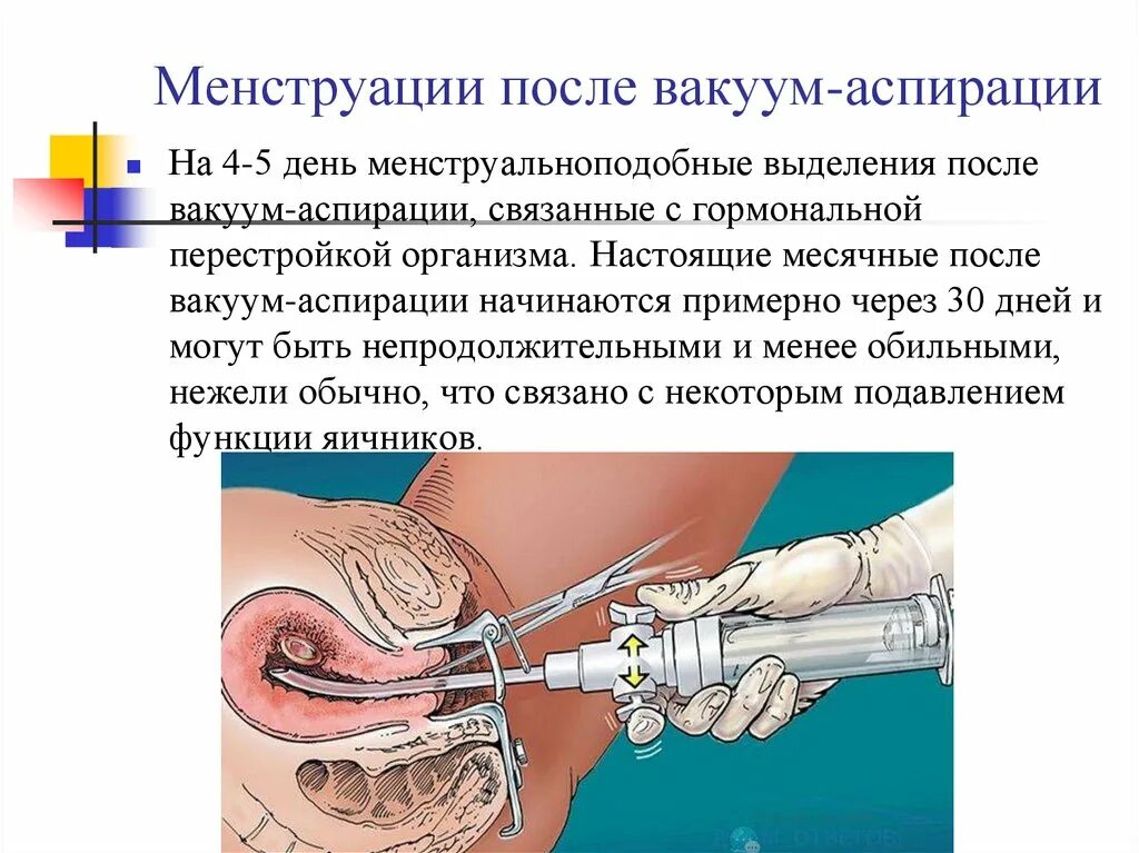 Выделения после вакуумной аспирации. Вакуумная аспирационная биопсия эндометрия. Мини-аборт (вакуум-аспирация). Вакуумная аспирация полости матки. Вакуумная оперция матки.