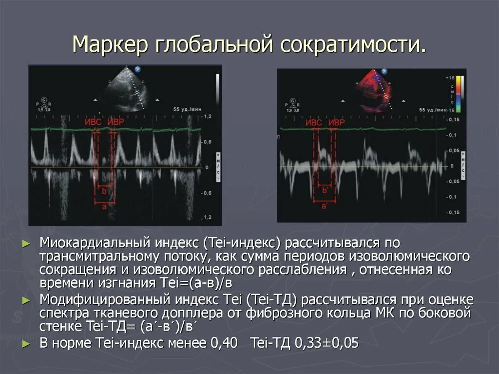 Снижением сократимости. Индекс Теи эхокардиография. Tei индекс ЭХОКГ. Тканевая допплерография в эхокардиографии. Фибрилляция предсердий и эхокардиография.