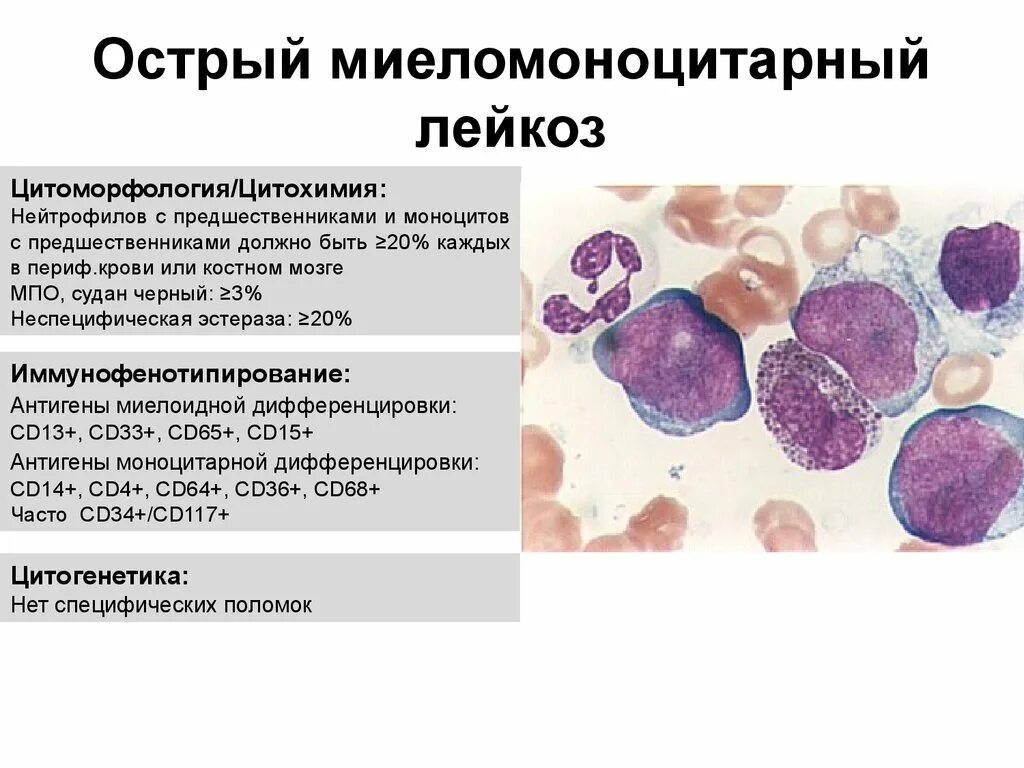 Острый миелоидный лейкоз картина крови. Острый моноцитарный лейкоз картина крови. Миеломоноцитарный лейкоз хронический лейкоз. Острый миелобластный лейуозкартина крови.