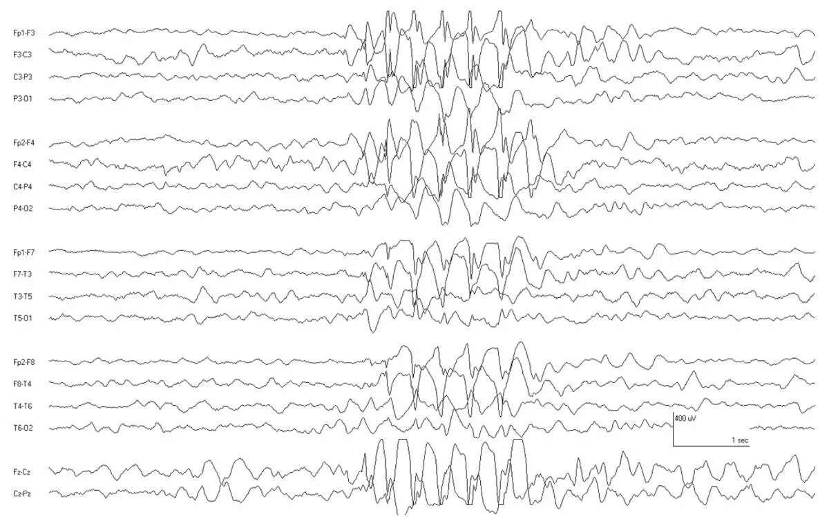 Спайки на ээг. Спайк волна на ЭЭГ. Спайк волны на ЭЭГ при миоклонии. Низкоамплитудные спайки на ЭЭГ.