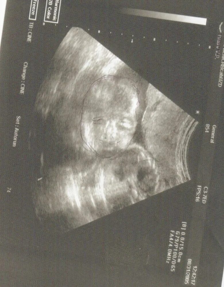 головное положение плода на 20 неделе беременности. положение плода узи. узи ребенка на 29 неделе беременности. плод в тазовом положении на узи. узи плода 29 недель беременности.