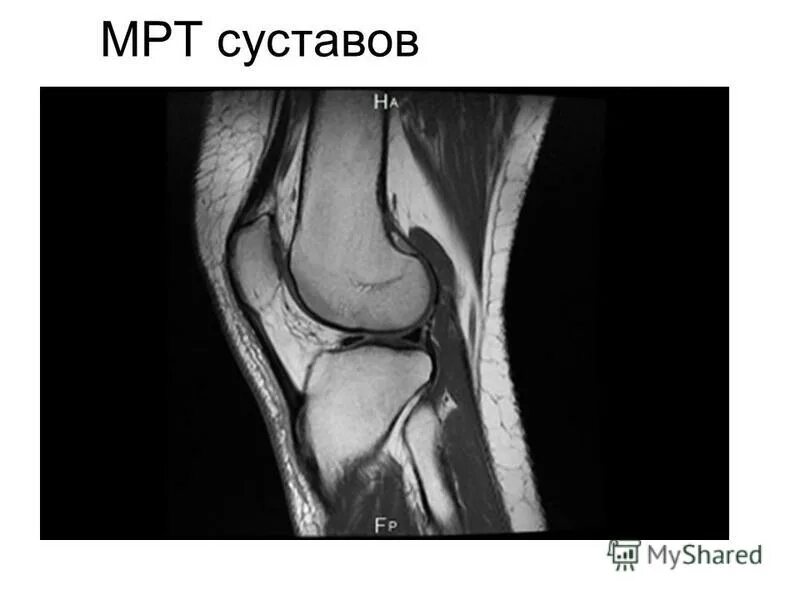 снимок мрт коленного сустава с разрывом мениска. мрт колена красноярск. мрт 3 тесла коленного сустава. мрт коленного сустава минск. мрт колена красноярск.