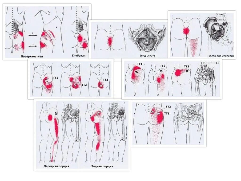 Квадратная поясничная мышца триггерные точки. Триггерные точки поясницы в области таза. Триггерные точки тазобедренного сустава и бедра. Триггерные точки при трохантерите. Иррадиация боли в бедре