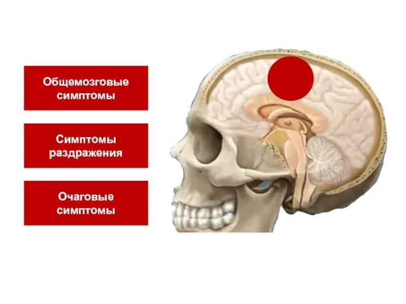 Общемозговые изменения регуляторного характера. Опухоль в голове симптомы. опухоль головного мозга симптомы. общемозговые симптомы опухоли. общемозговые симптомы при опухолях головного мозга.