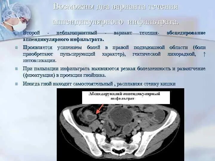 Аппендикулярный инфильтрат на кт. Аппендикулярный инфильтрат. Аппендикулярный инфильтрат кт картина. Инфильтрат брюшной полости на УЗИ.