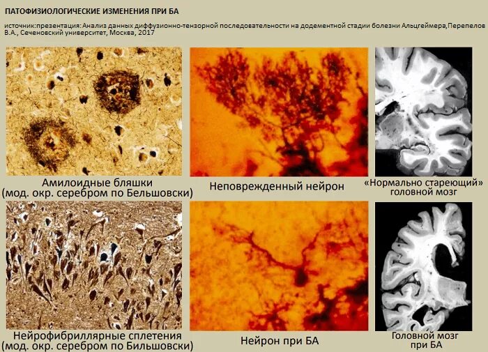 Дегенерация головного. Сенильные бляшки при болезни Альцгеймера. Болезнь Альцгеймера амилоидные бляшки. Болезнь Альцгеймера Патан. Болезнь Альцгеймера патологическая анатомия.