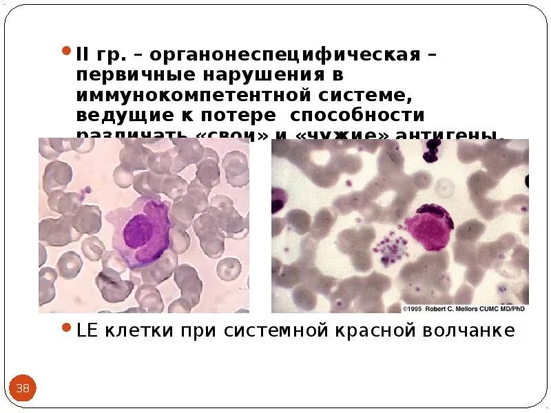 Системная красная волчанка le клетки. Le клетки при системной красной волчанке. Le феномен клетки красной волчанки.
