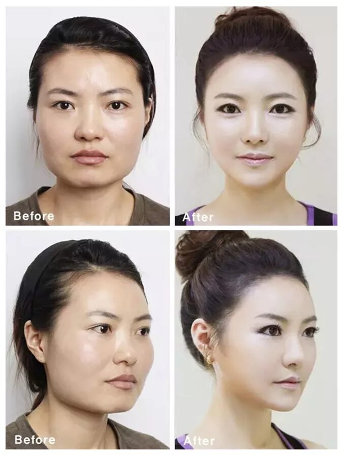 Азиатское лицо до и после пластики. Кореянки до и после пластики глаз. Пластика на глаза до и после у кореянок. Пластика азиатского лица.