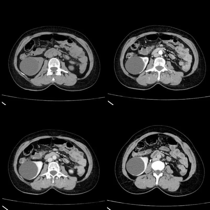 Контрастирование почек кт. Многослойная компьютерная томография. Кт аксиальный срез красное контрастирование. Разница кт и кт с контрастом