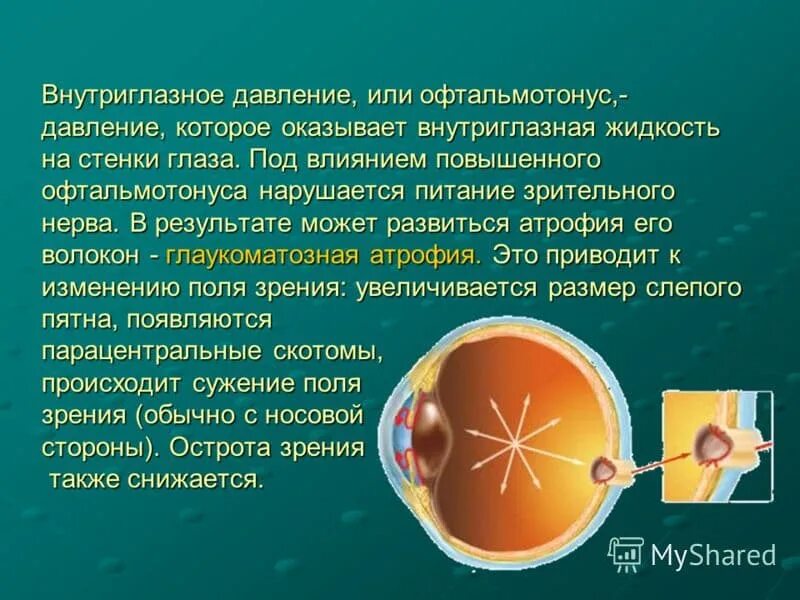 Внутриглазное давление причины. Внутриглазное давление. Высокое внутриглазное давление. Внутреннее глазное давление.