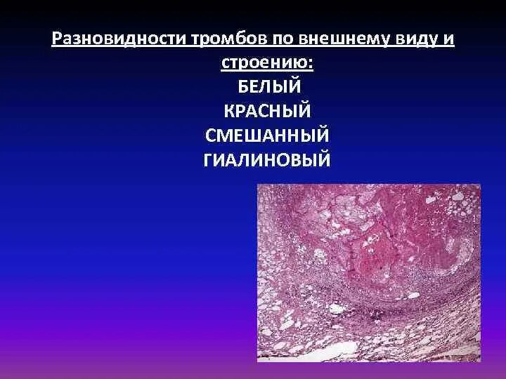 Смешанный тромб. Гиалиновый тромб гистология. Гиалиновый тромб патологическая анатомия. Красный тромб патанатомия.