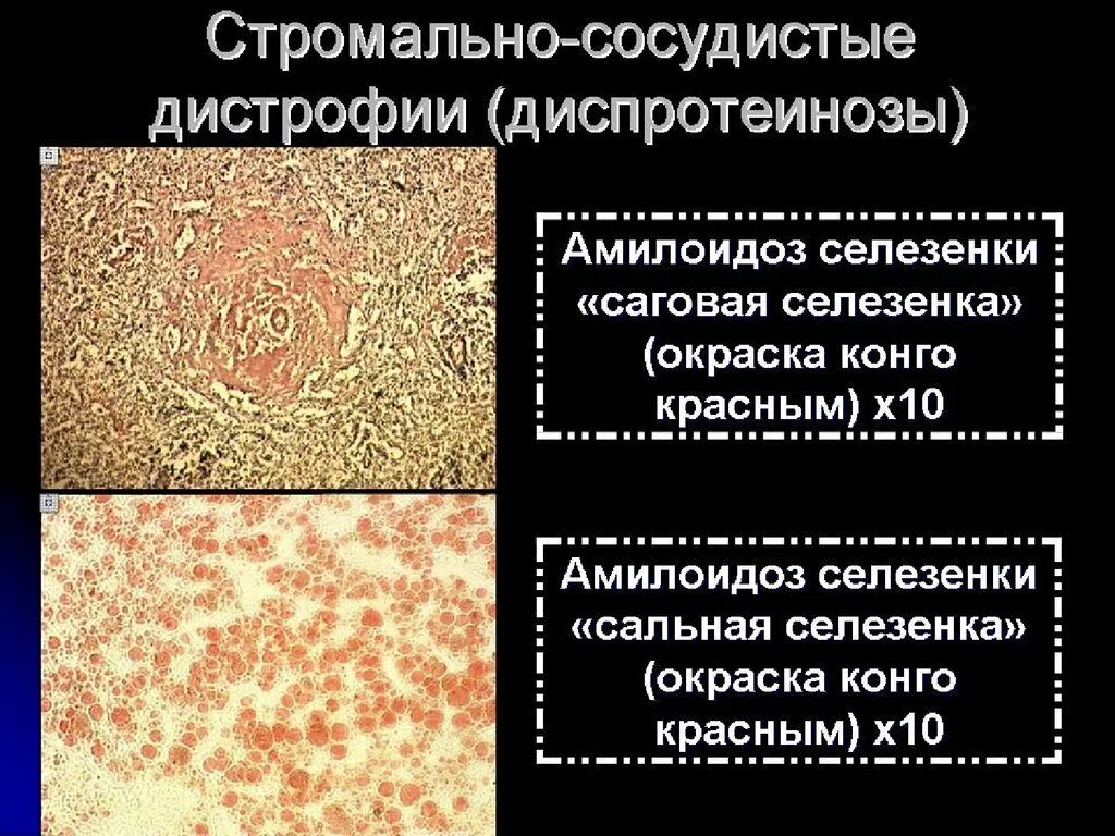 Белковые мезенхимальные дистрофии. Амилоидоз дистрофия микроскопия. Белковые мезенхимальные дистрофии гиалиноз. Мезенхимальные дистрофии таблица фибриноидное набухание. Мезенхимальные дистрофии таблица гиалиноз.