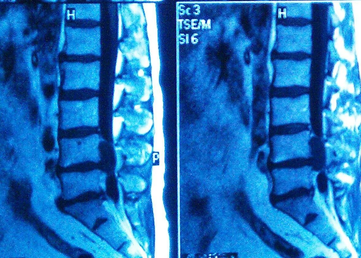 После операция грыжа диска. Секвестрированная грыжа l4-s1. Секвестрированная грыжа позвоночника l5-s1. Грыжа диска l4-l5. Секвестрированная грыжа l5-s1 мрт.