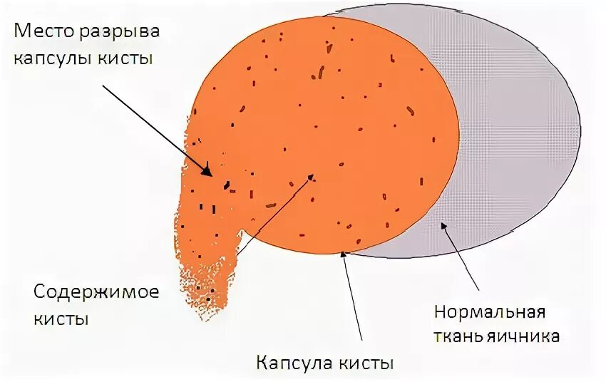 Разрыв капсулы кисты яичника.