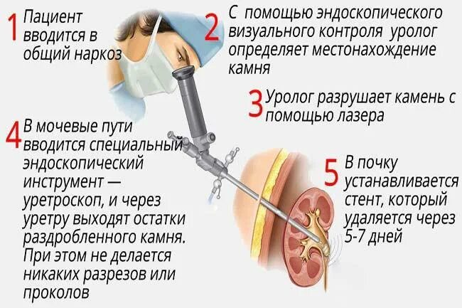 Удаление стенда из мочеточника. Лазерная литотрипсия мочеточника. Стент после дробления камня в почке. Литотрипсия камней в мочеточнике. Стенд в мочеточнике при камнях.