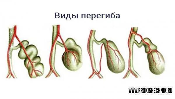 Загиб желчного симптомы у взрослых. Деформированный желчный пузырь с перегибом. s образная деформация желчного пузыря. в н/ перегиб желчного пузыря. функциональный загиб желчного пузыря.