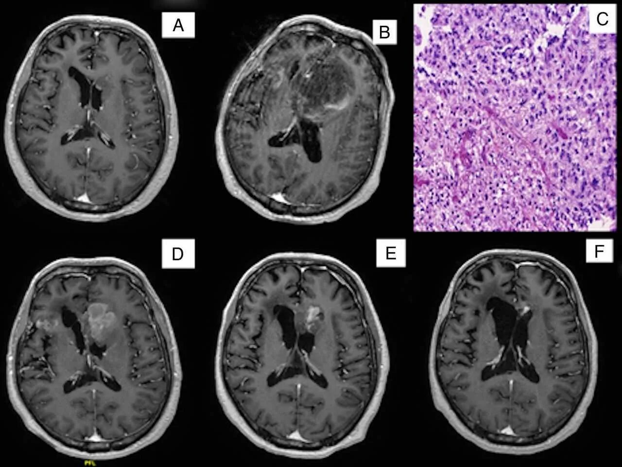 Опухоль мозга глиобластома. Полиморфная глиобластома. Мультиформная глиобластома мрт. Мультифокальная глиобластома кт.