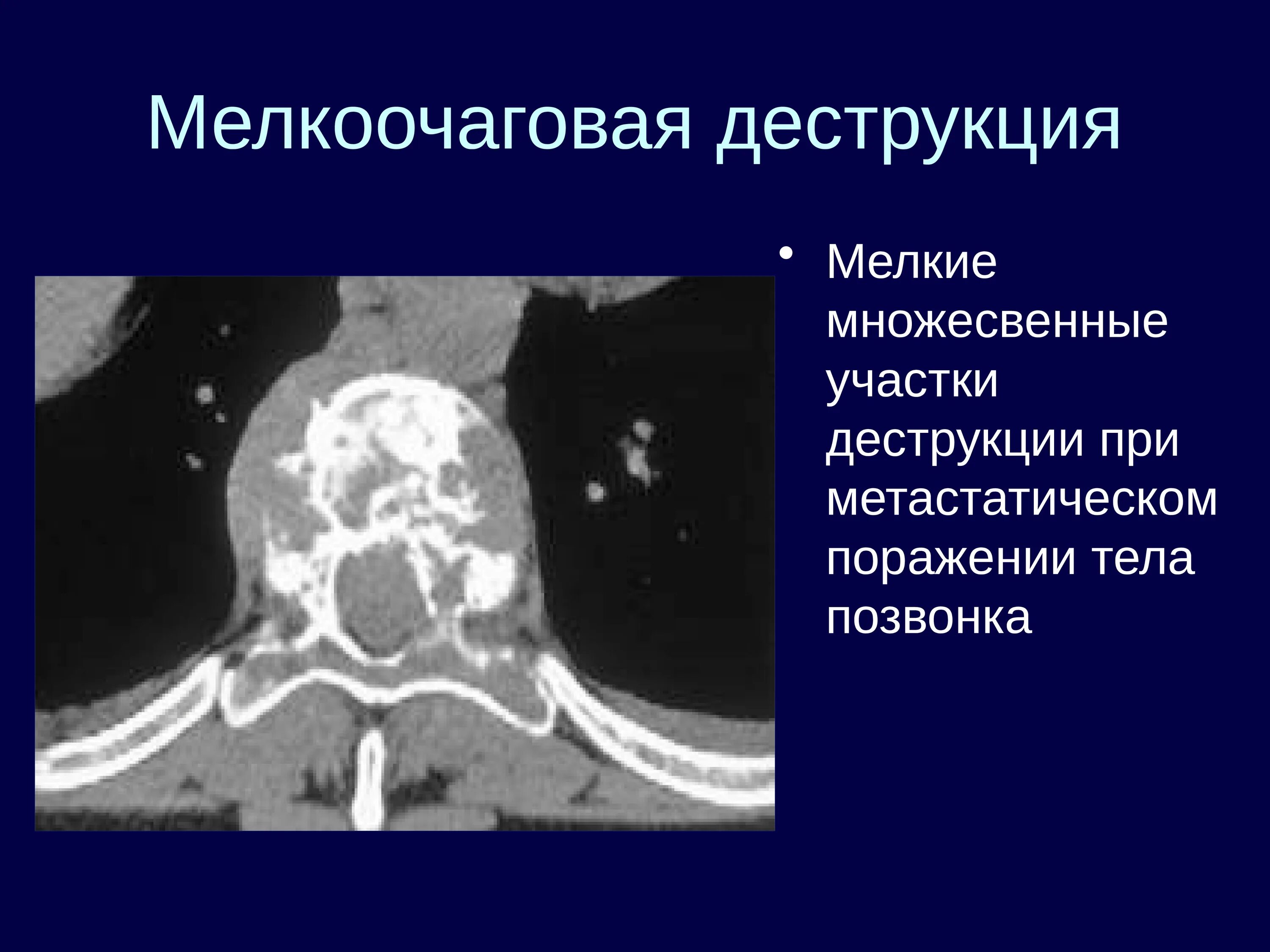 Метастатическое поражение кости. Деструкция тела позвонка на кт. Метастатическое поражение позвоночника. Деструкция тела позвоночника при кт. Мелкоочаговая деструкция кт.