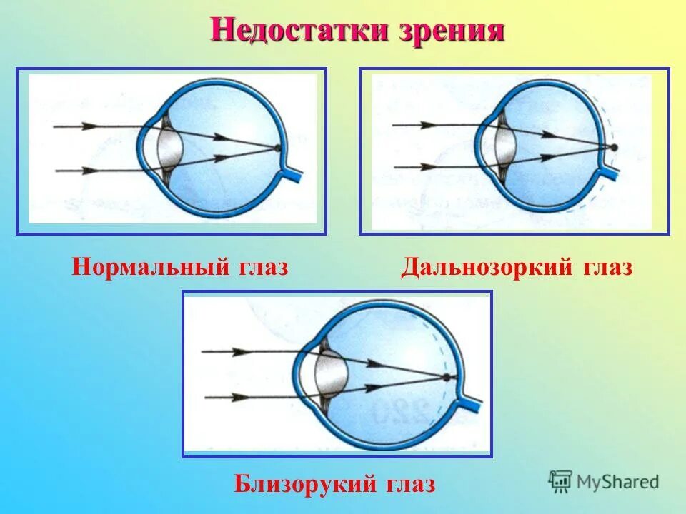 Дефекты зрения физика кратко. Дефекты зрения. Недостатки зрения. Дефекты зрения и их коррекция. Схема распространения лучей в близоруком глазу.