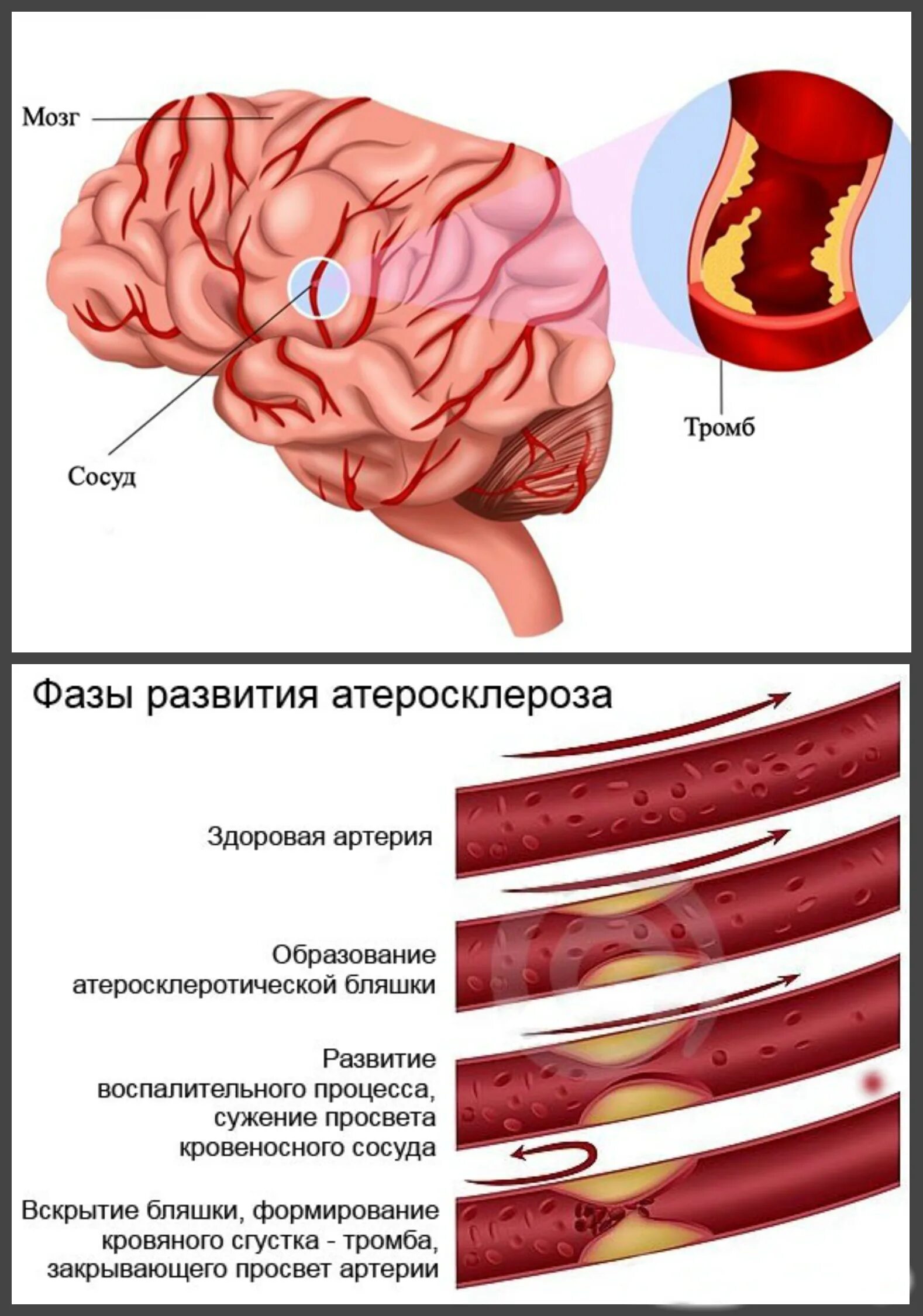 Атеросклероз церебральных сосудов симптомы. Атеросклероз сосудов головного мозга. Атеросклероз сосудов головы. Атеросклероз артерий головного мозга. Атеросклероз сосудов головы и шеи.
