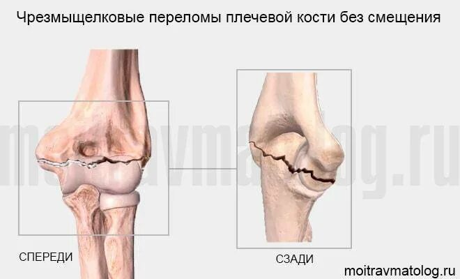 Перелом мыщелка плечевой кости у детей. Чрезмыщелковые переломы плечевой кости у детей. Чрезмыщелковый перелом плечевой. Чрезмыщелковые переломы плечевой кости.