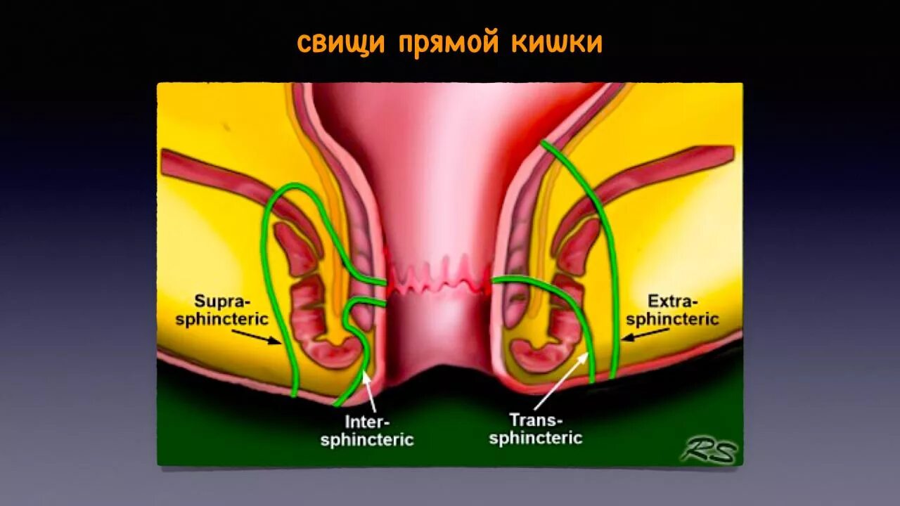 Транссфинктерный свищ прямой кишки. Интрасфинктерный свищ. классификация свищей заднего прохода. экстрасфинктерный свищ прямой кишки.
