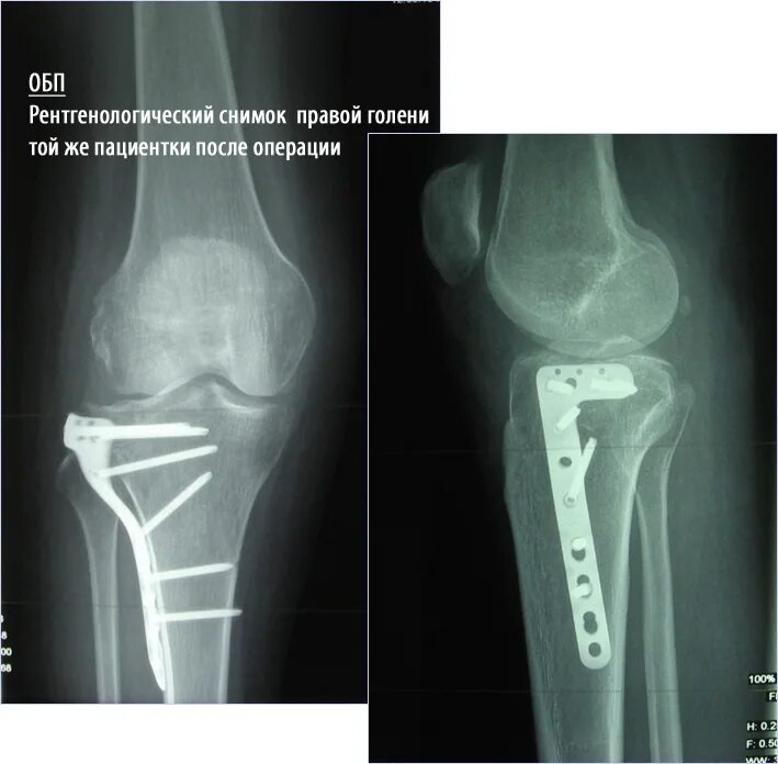 Перелом мыщелков большеберцовой кости. Консолидированный перелом мыщелка большеберцовой кости рентген. Компрессионный перелом колена. Перелом мыщелка коленного сустава рентген. Перелом проксимального отдела большеберцовой кости мкб 10.