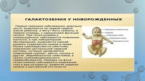 Нарушения обмена галактозы галактоземия по утвержденным клиническим
