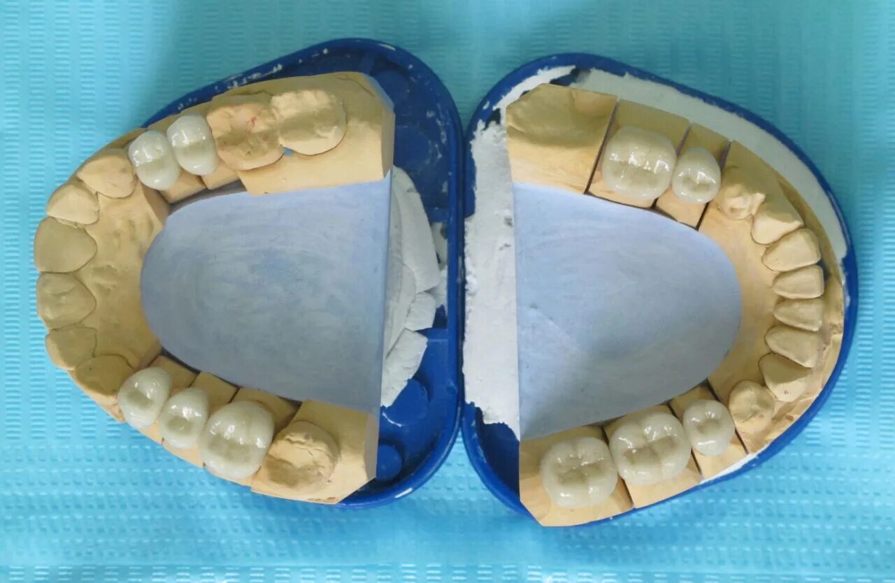 Металлокерамика мостовидные протезы. Металлокерамика коронки протез мостовидный. Мостовидный протез металлокерамика на 4 зуба. Керамические мосты для зубов. Лабораторные этапы металлокерамической коронки