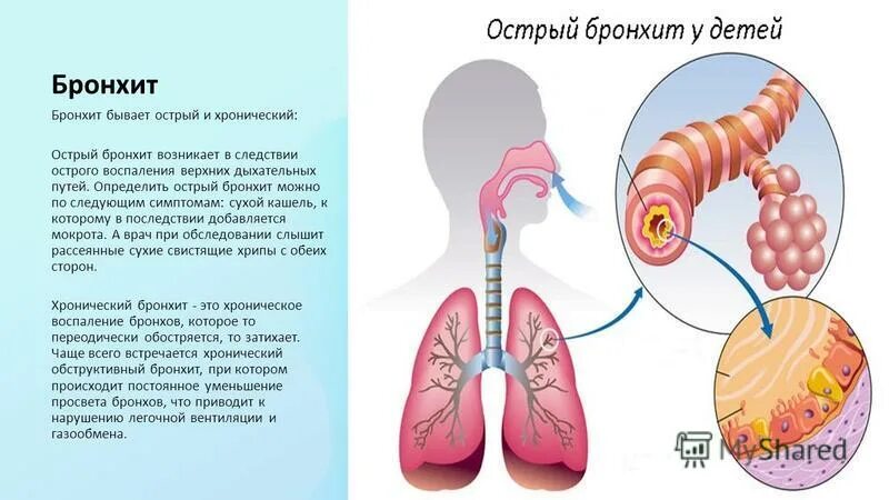 Симптомы туберкулеза кашель. Выпишут ли с кашлем. Проявление туберкулеза. Коклюша у детей симптомы коклюша. Выпишут ли с кашлем.
