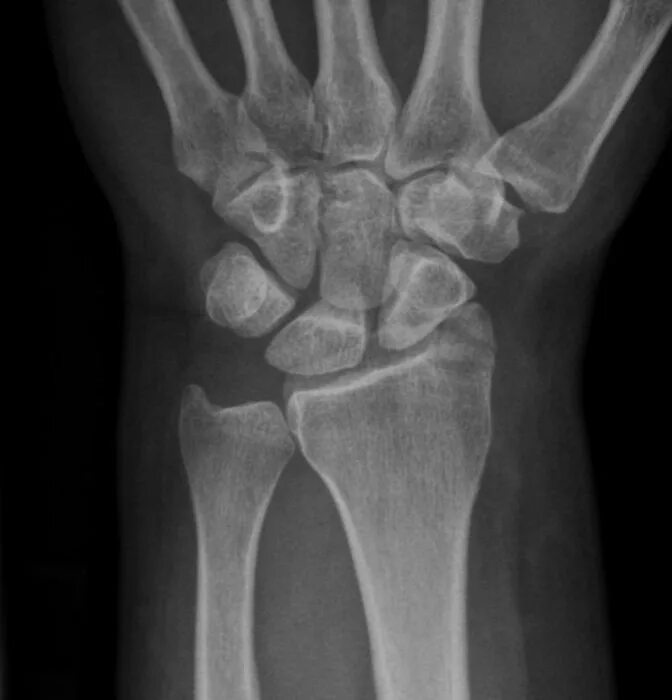 Перелом шиловидного отростка рентген. Перелом лучезапястного отростка. Лучевая кость шиловидный отросток перелом. Шиловидный отросток лучезапястной кости. Шиловидный отросток лучевой кости анатомия.