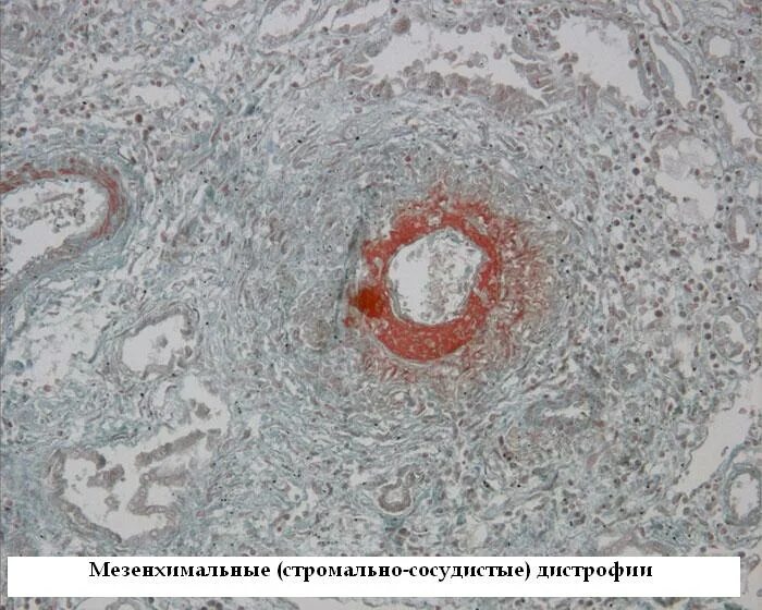 Белковые мезенхимальные дистрофии. Мезенхимальная углеводная дистрофия. Стромально-сосудистые углеводные дистрофии. Углеводная мезенхимальная дистрофия это в патологии. Углеводные стромально-сосудистые дистрофии микропрепарат.