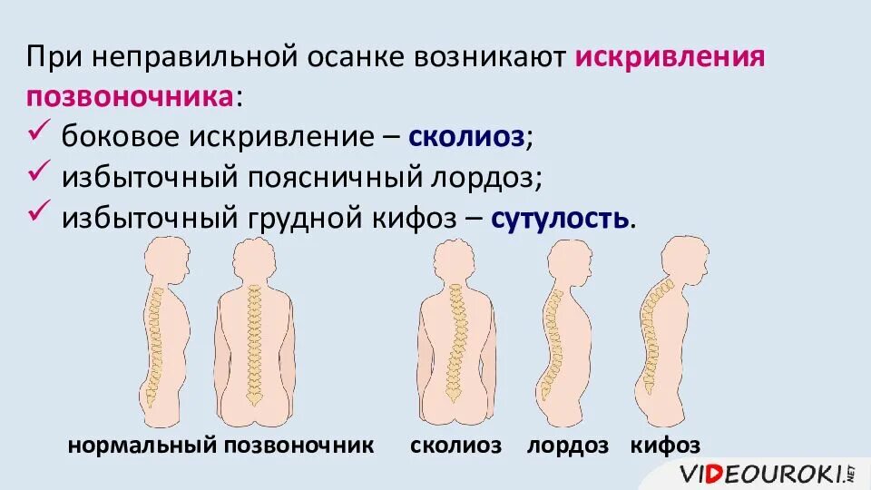 Нарушения осанки возникают. Нарушение осанки лордоз кифоз сколиоз. осанка нарушение осанки плоскостопие. деформации позвоночника кифоз лордоз сколиоз. нарушение осанки и плоскостопие.