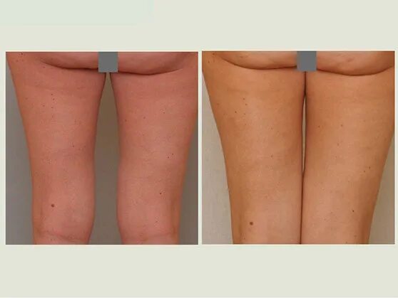 пластические операции на бедрах. подтяжка бедер. подтяжка бедер. липосакция и подтяжка бедер. лпж галифе.