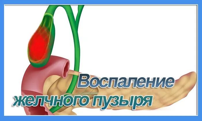 Восполениежелчногопузыря. Воспаление желчного пузыря. Воспаление желчного пузыря лекарства. Воспаление желчного пузыря может быть.