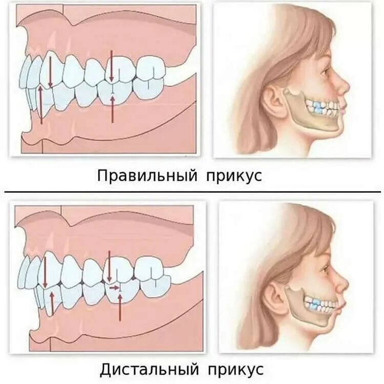 Почему не открывается рот. Дистальный (прогнатический) прикус. Дистальный и мезиальный прикус. Дистальный прикус прогнатия.