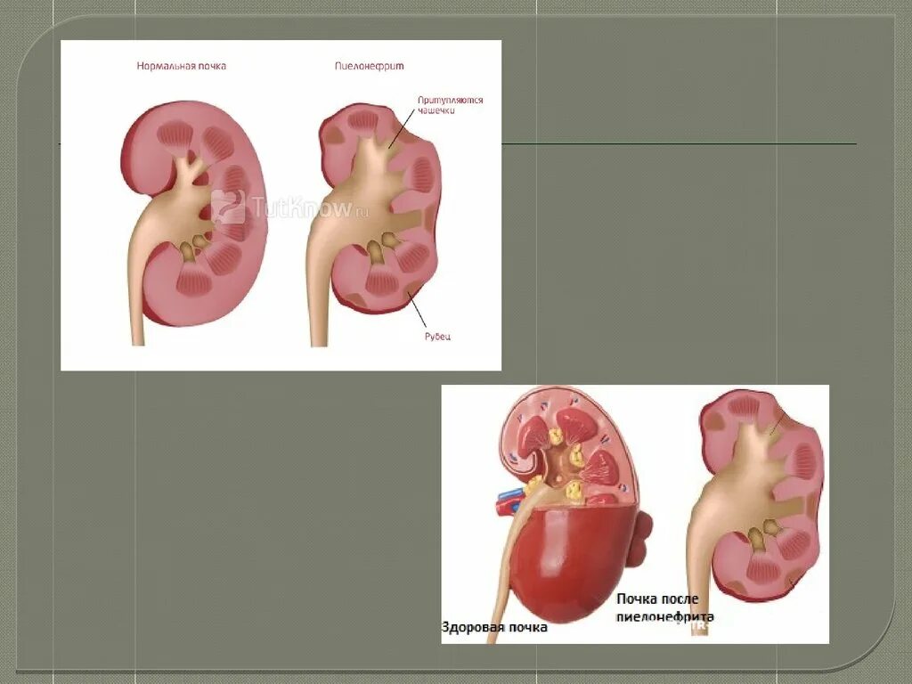 Пиелонефрит картина почки. Острый и хронический пиелонефрит. Изменение почки при пиелонефрите. Пиелонефрит презентация.