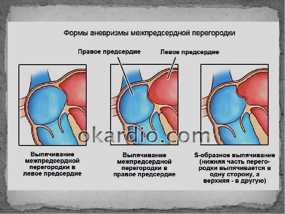 Аневризма перегородки у ребенка. Типы аневризмы межпредсердной перегородки. Аневризматическое выбухание МПП У новорожденных. R Тип аневризмы межпредсердной перегородки. Классификация аневризм межпредсердной перегородки.