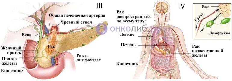 4 стадия поджелудочной железы сколько живут. Лимфатические узлы поджелудочной железы. Регионарные лимфоузлы поджелудочной железы. Метастазы поджелудочной железы. Лимфоузлы при опухоли поджелудочной железы.