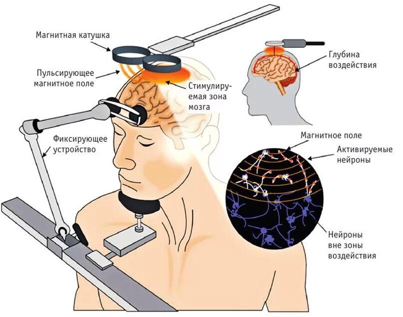 Стимуляция мозга ребенка. Транскраниальная магнитная стимуляция (ТКМС). Аппарат транскраниальной магнитной стимуляции. Транскраниальная электростимуляция мозга аппарат. Транскраниальная магнитная стимуляция\ схема.