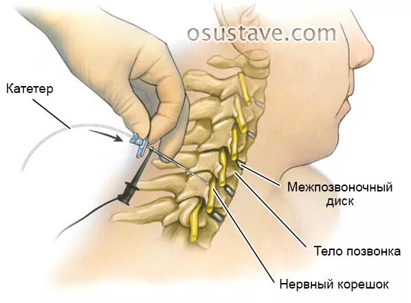 Блокада в шею. Паравертебральные блокады шейного отдела. Паравертебральная блокада шейного отдела техника. Паравертебральные блокады поясничного отдела. Паравертебральная блокада шейного отдела позвоночника.